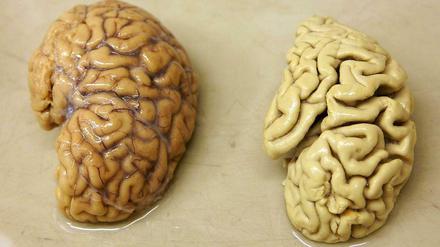 Das Gehirn eines Alzheimer-Patienten ist deutlich geschrumpft.