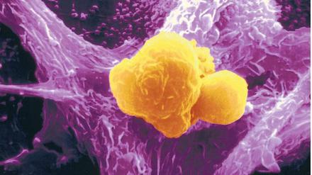Heilsame Attacke. Wie mit riesigen Krakenarmen hat eine Fresszelle des Immunsystems gelb eingefärbte Krebszellen eingefangen und ist dabei, sie zu verschlingen. Solche Prozesse sollen durch Krebsimpfungen stimuliert werden. 