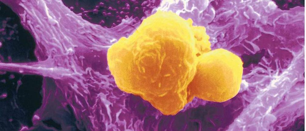 Heilsame Attacke. Wie mit riesigen Krakenarmen hat eine Fresszelle des Immunsystems gelb eingefärbte Krebszellen eingefangen und ist dabei, sie zu verschlingen. Solche Prozesse sollen durch Krebsimpfungen stimuliert werden. 