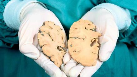 Geschrumpft. Ein Pathologe zeigt im Vergleich das Hirnpräparat eines Alzheimer-Patienten (links) mit deutlichem Substanzverlust und das eines Gesunden. Foto: Focus/SPL
