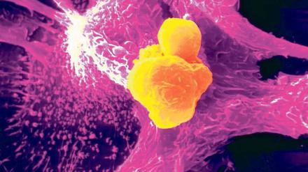Gefahr gebannt. Auf dieser rasterelektronenmikroskopischen Aufnahme ist gut zu erkennen, wie Krebszellen (gelb eingefärbt) einer Abwehrzelle des Immunsystems („Fresszelle“, violett eingefärbt) „ins Netz gehen“ und verdaut werden. Eine Chemotherapie kann solche Strategien des Körpers gegen Tumorzellen offenbar stimulieren. Foto: Mauritius