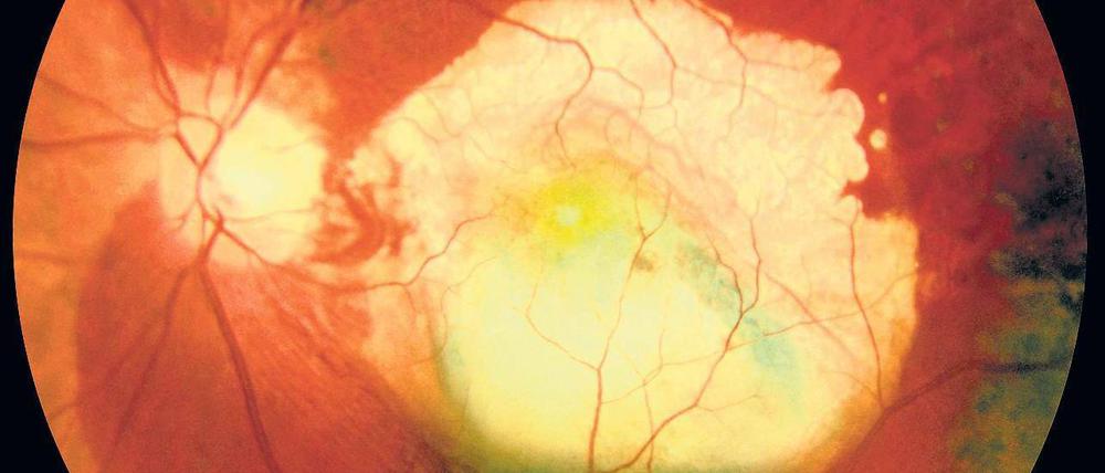 Blind im Zentrum. Bei der Makuladegeneration werden ausgerechnet jene Sinneszellen des Auges zerstört, die das Zentrum des Sehens ausmachen. Auf dem Netzhaut-Foto ist zu sehen, dass bei diesem Kranken ein großes Areal bereits verblasst und abgestorben ist.