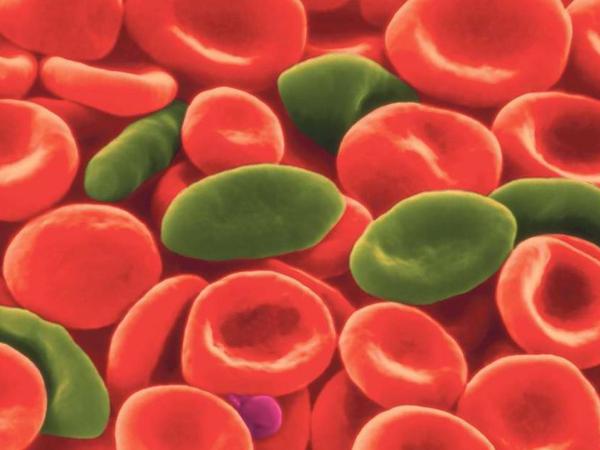 Rote Blutkörperchen (rot) können sich aufgrund einer Mutation zu Sichelzellen (hier grün markiert) verformen. Eine Gentherapie mit der Gen-Schere Crispr/Cas9 kann das jetzt offenbar korrigieren. 