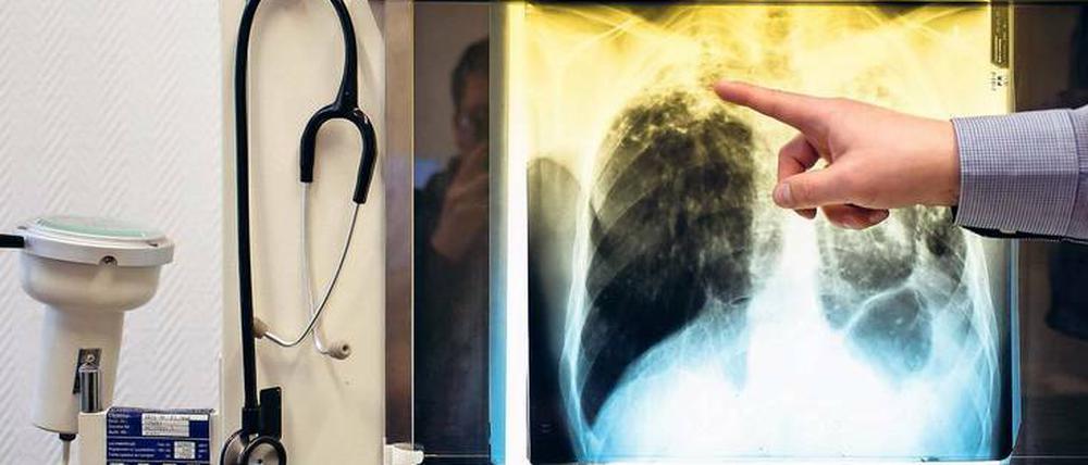 Gefährlich. Wenn Flecken auf der Lunge erkennbar sind, ist die Tuberkulose schon fortgeschritten. Eine frühzeitige Diagnose könnte eventuell die Therapie erleichtern.