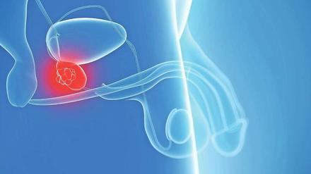Die von Nervenbahnen durchzogene Prostata liegt unter der Harnblase. Wenn die Drüse von Krebs befallen ist und anschwillt, erhöht sich der Gehalt an PSA-Protein im Blut.