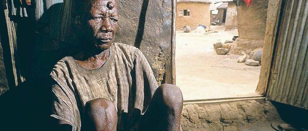 Erkrankt. Die Flussblindheit, eine von Mücken übertragene Wurmkrankheit, machte diesen Patienten in Nigeria zum Pflegefall. 
