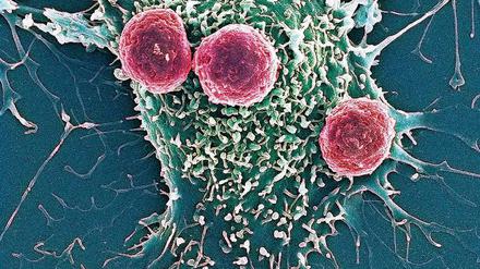 Körpereigene Waffe. T-Zellen (violett eingefärbt) attackieren eine Tumorzelle.