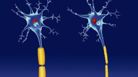 Gesunde Nervenzellfortsätze (links) sind von speziellen Hüllen, sogenannten Myelinscheiden, umgeben. Sie beschleunigen die Reizübertragung. Bei Multipler Sklerose zerstört das Immunsystem diese Hüllen.(rechts).