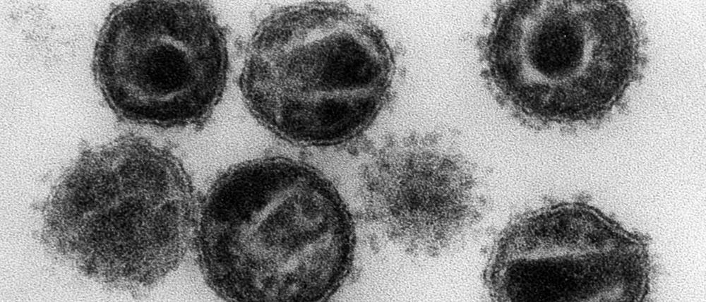 Mehrere Humane Immunschwäche-Viren (HIV) unter dem Elektronenmikroskop.