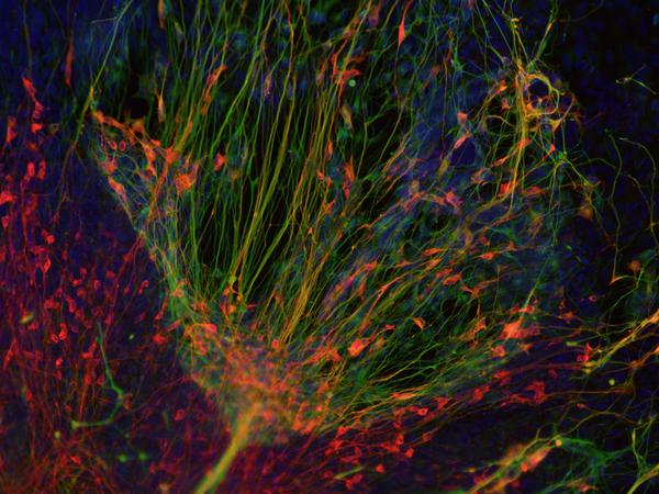 Forscher stellen die Vorgänge bei Parkinson im Labor nach: Aus Zellen von Patienten werden Stammzellkulturen hergestellt, aus denen dann dopaminerge Nervenzellen (rot) hergestellt werden, die bei der Schüttellähmung zugrunde gehen. (grün: andere Nervenzellen; blau: Zellkerne)