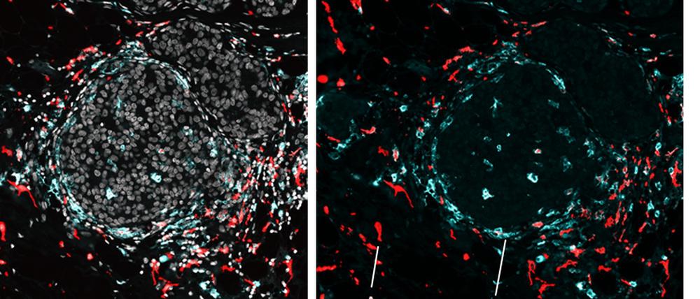 Immunzellen des Makrophagen-Typs, links das Immunsystem behindernd, rechts aktiv in der Bekämpfung von Maus-Tumor-„Nestern“