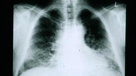 Röntgenaufnahme der Lunge eines Patienten mit Fibrose, eines übermäßigen Wachstums von Bindegewebszellen. 