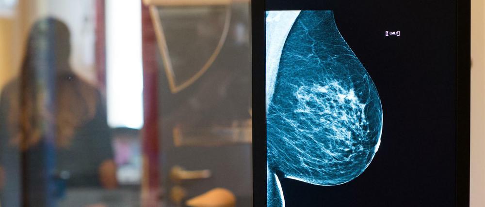 Hormonersatztherapien, die länger als ein Jahr dauern, erhöhen das Brustkrebsrisiko. 