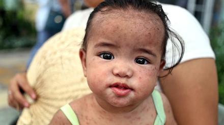 Ein philippinisches Kind, das an Masern leidet, wird in einem Krankenhaus behandelt.