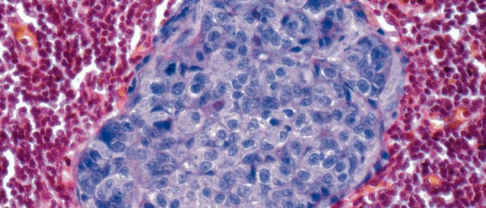 Krebsnest. Die mikroskopische Aufnahme zeigt gestreute Brustkrebszellen (blau gefärbt) in einem Lymphknoten (rot eingefärbt).