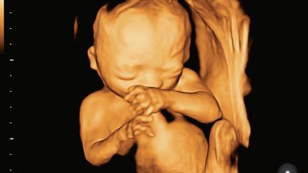 Mit einem 3-D-Ultraschall lassen sich eventuelle Fehlbildungen des Ungeborenen erkennen, die nicht immer eine vermeidbare Ursache haben, sondern mitunter einfach „zufällig“ passieren. 
