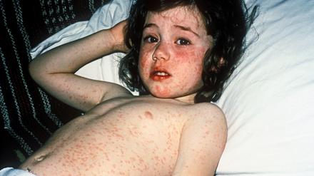 Ansteckend. Das Masernvirus ist hochinfektiös. 90 Prozent der Menschen, die nicht immun sind und mit einem Erkrankten in Berührung kommen, stecken sich an. 